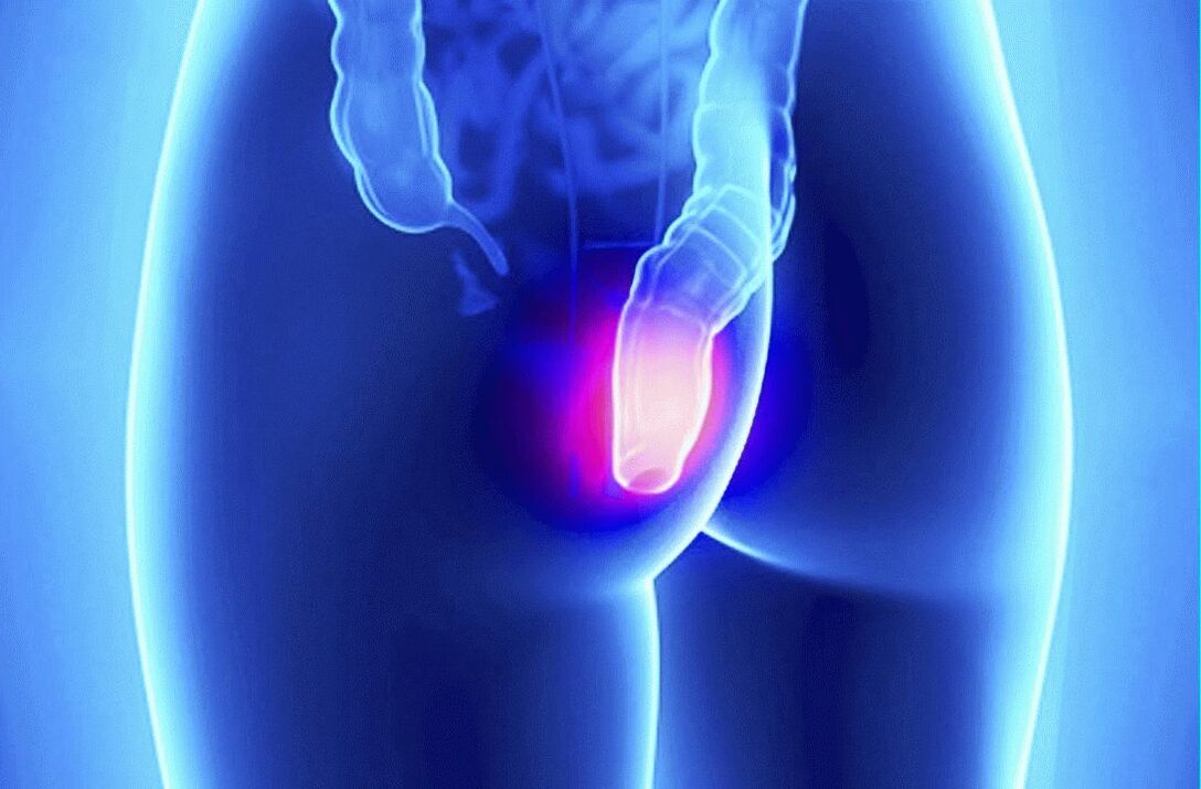 Gelarex lze použít jak zevně, tak rektálně